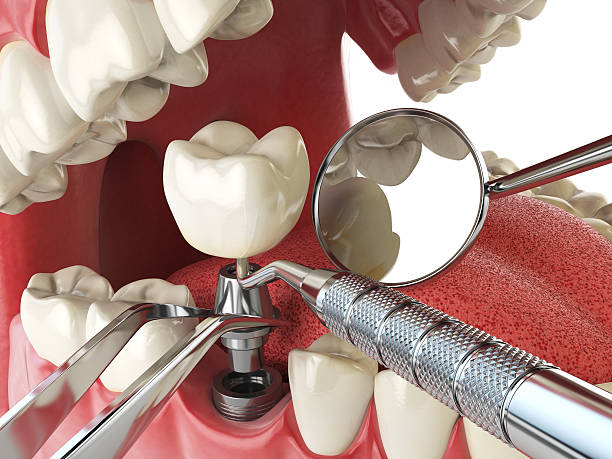 Best Urgent Tooth Repair  in Patterson Tract, CA
